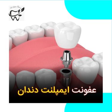 عفونت ایمپلنت دندان، دکتر سحر طهرانی، تهران